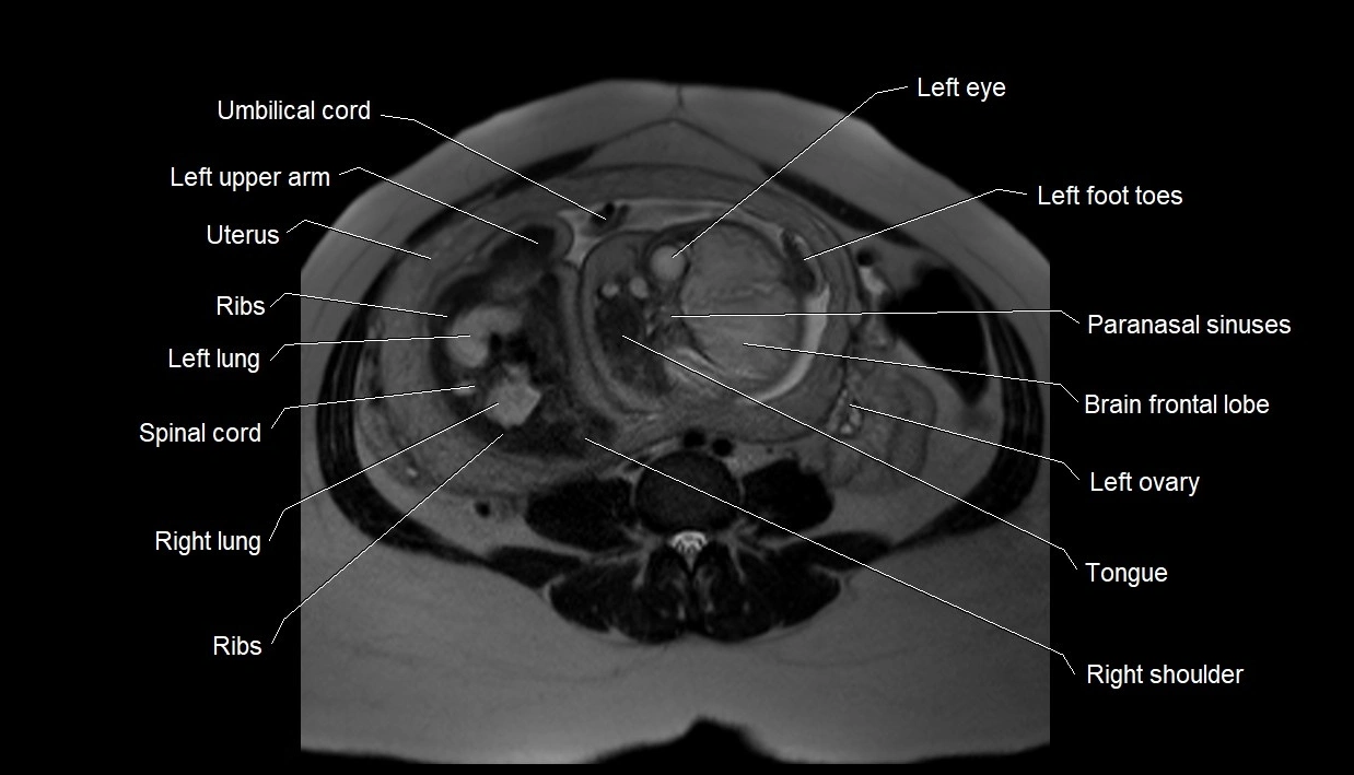 MRI fetal anatomy axial image 17.webp